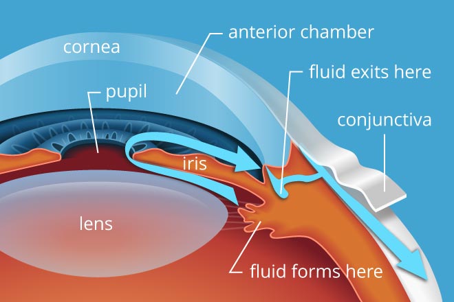 Glaucoma