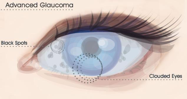 Glaucoma
