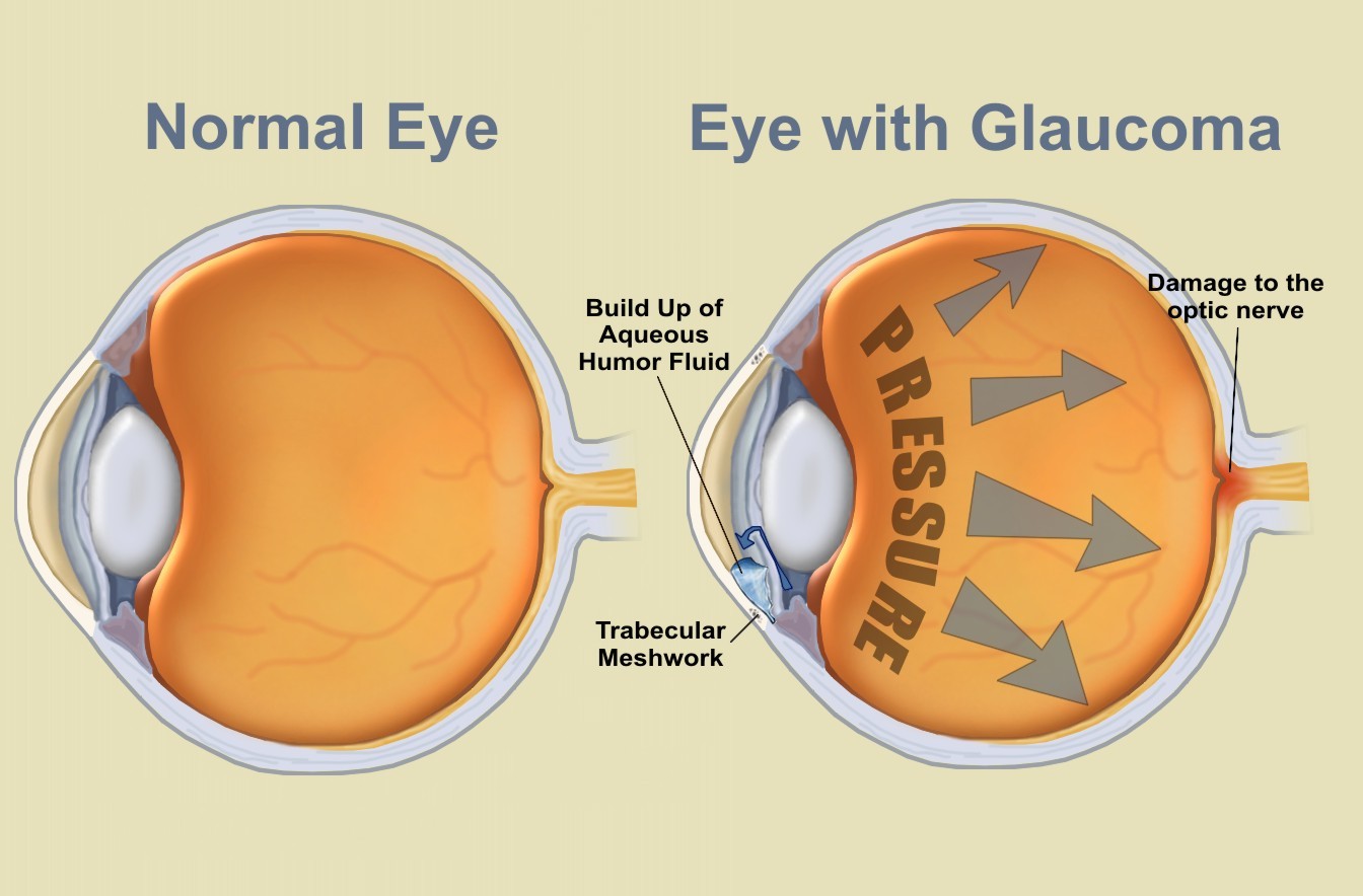 glaucoma-is-caused-by