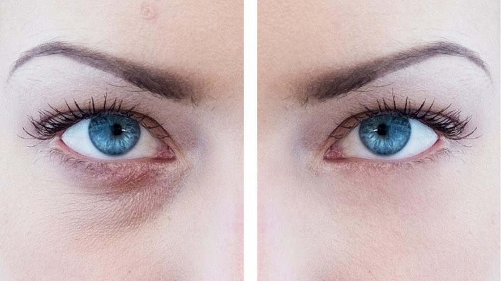 how-to-remove-bags-from-under-your-eyes