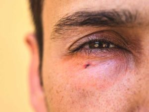 Swollen eyes symptoms