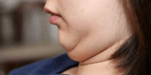 Double Chin