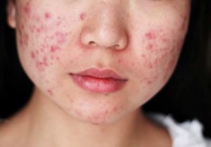 Acne Scars