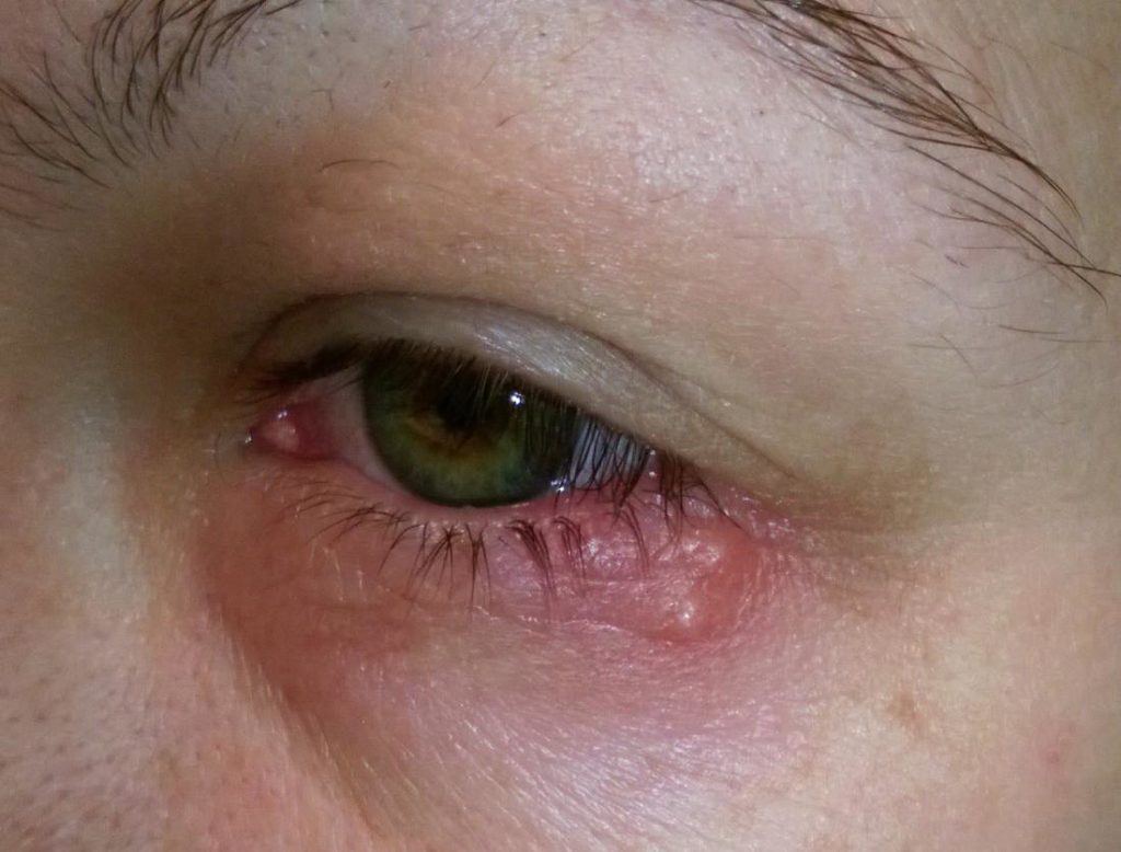 Eye Herpes