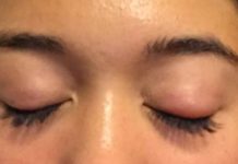 how-to-get-rid-of-a-swollen-eye-fast