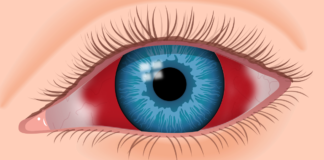 Eye Hemorrhage