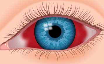 Eye Hemorrhage