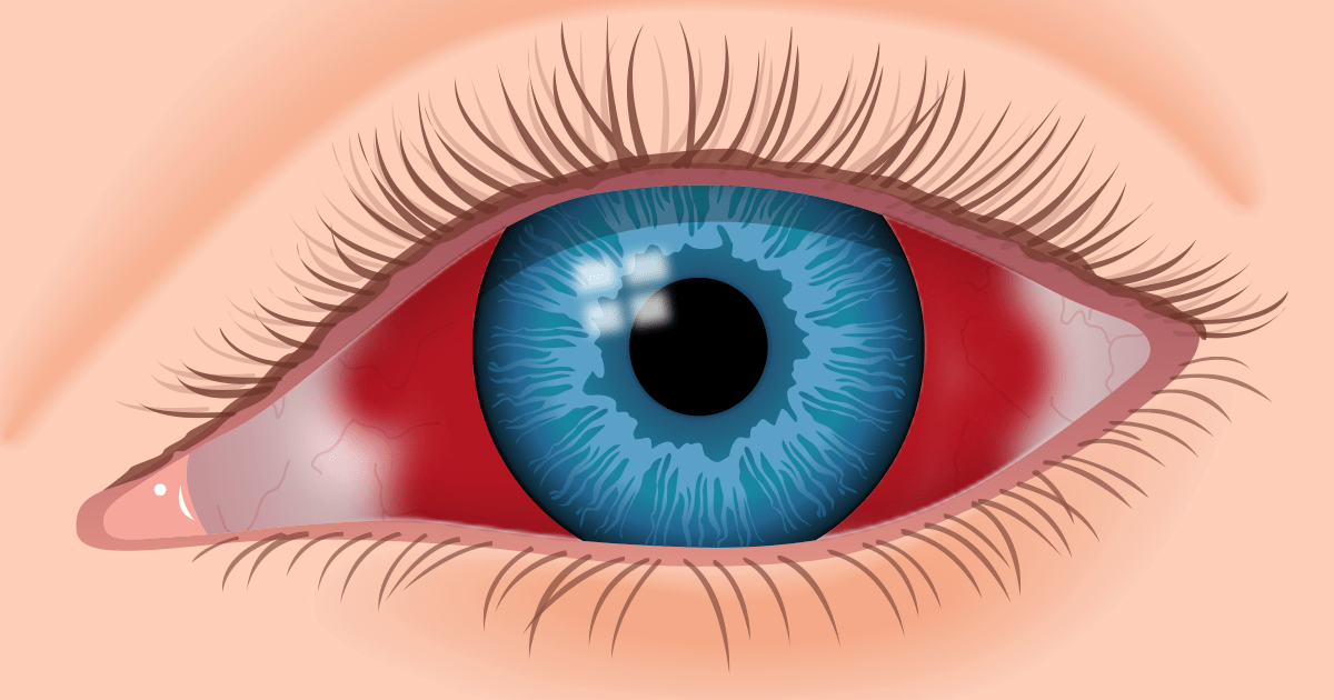 Busted Blood Vessel in Eye Causes and Treatement Luster Eyes