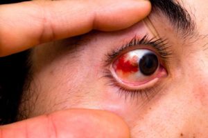 busted-blood-vessel-in-eye
