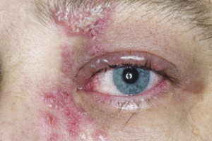 Eye Shingles