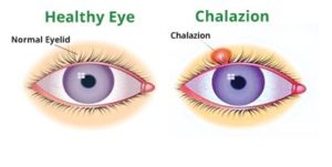 Chalazion Swollen Eyelid