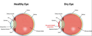 Causes of Dry Eyes
