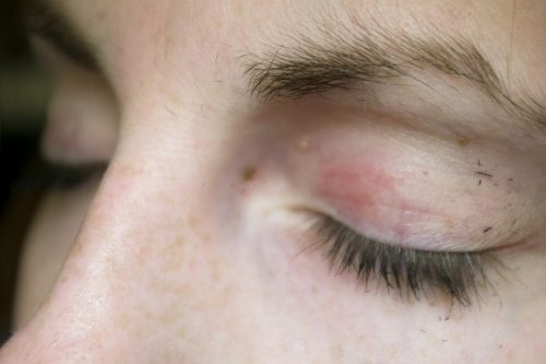 Everything You Need To Eye Shingles Early Causes And Treatments