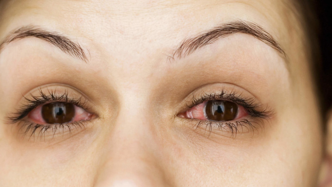 how-long-does-pink-eye-last-intro-symptoms-types-and-prevention