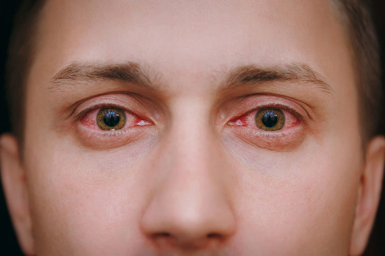 how-long-does-pink-eye-last-intro-symptoms-types-and-prevention