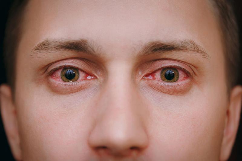 How long does Pink Eye Last Intro Symptoms Types And Prevention
