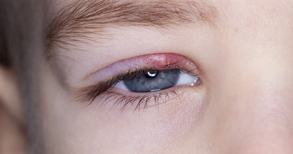 How To Get Rid of A Stye