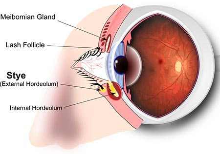 How To Get Rid of A Stye