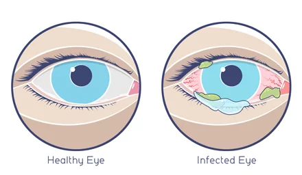 Person Become Contagious With Pink Eye