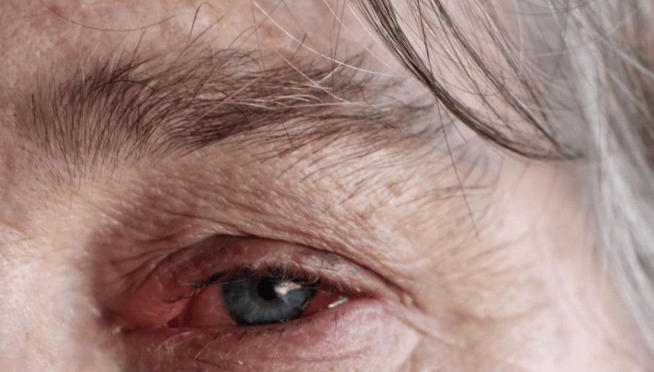 How Long Is a Person With Pink Eye Contagious