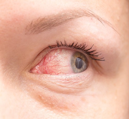 Acanthamoeba Keratitis Eye Infection 