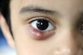 Avoid Swollen Eyelid