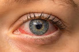 Eye Infection In Children