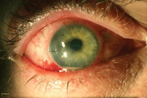 Eye Infection 