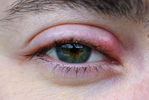 Avoid Swollen Eyelid