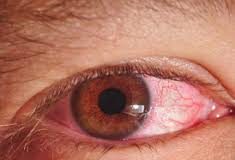 Eye Infection