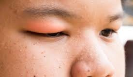 How To Avoid Swollen Eyelid