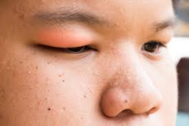 How To Avoid Swollen Eyelid