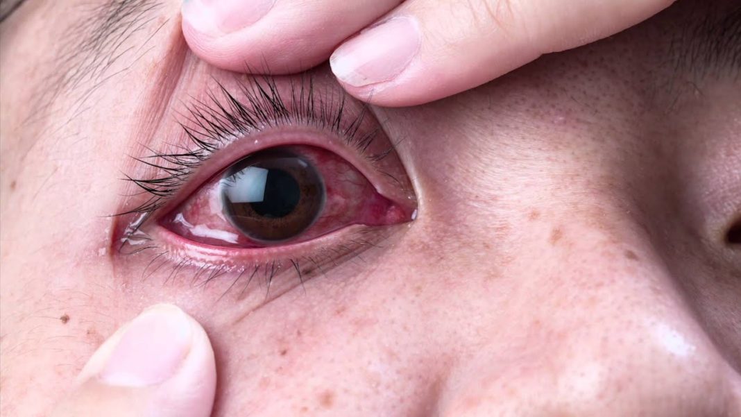 Kinds Of Eye Infections Symptoms Complications And Ways To Prevent Them