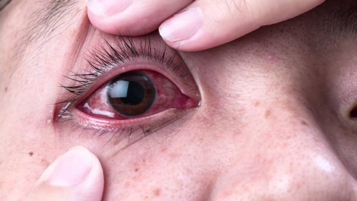 Kinds Of Eye Infections Symptoms Complications And Ways To Prevent Them 9661