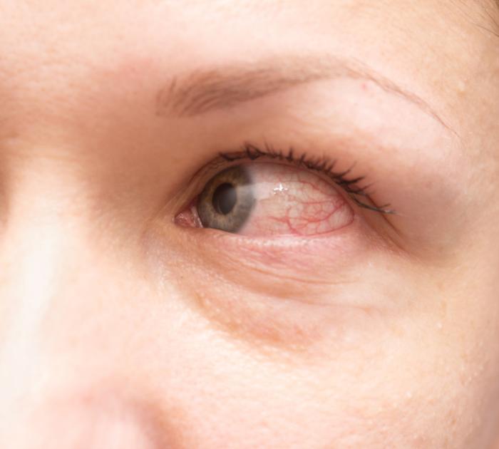 Avoid Swollen Eyelid