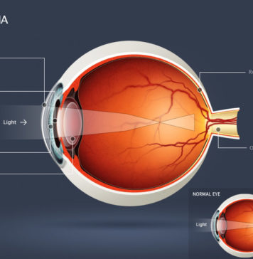 Myopia