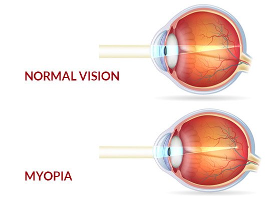 Myopia