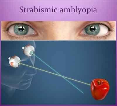 Amblyopia