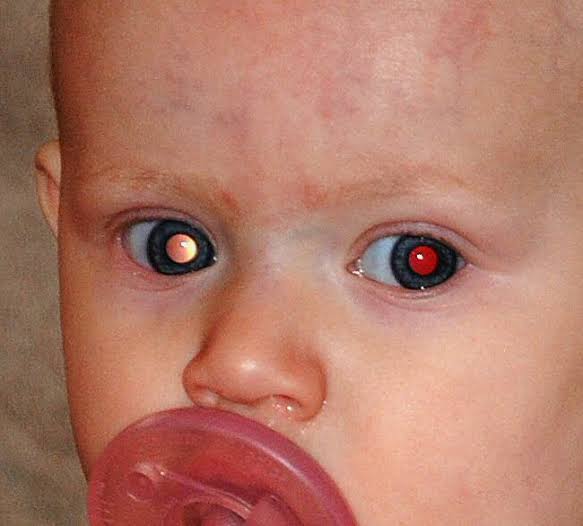 Retinoblastoma