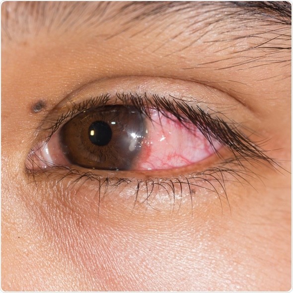 Common Eye Infections