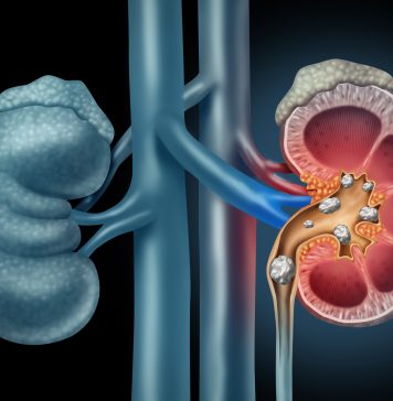 Kidney Stone