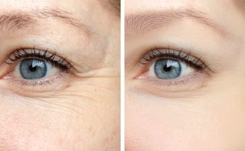 botox before and after eyes