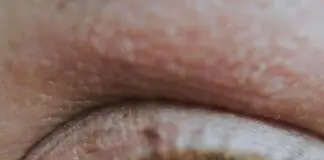 wrinkles and eye cream