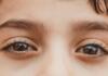 Under Eye Filler Before and After: