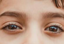 Under Eye Filler Before and After: