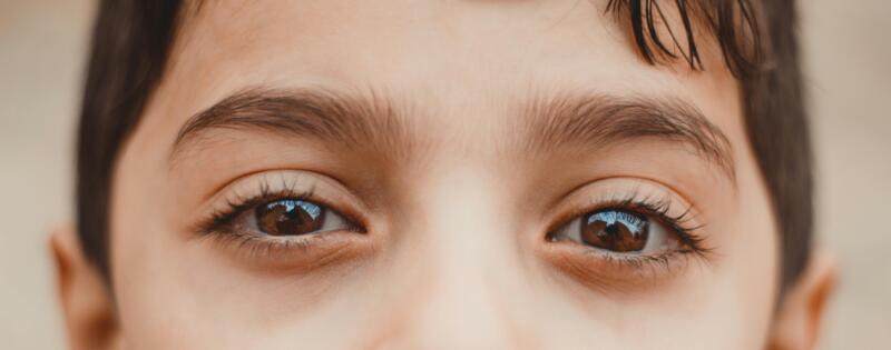 Under Eye Filler Before and After: