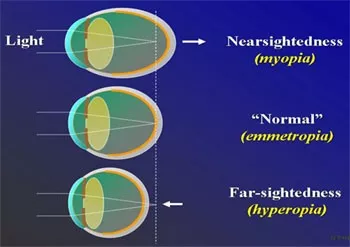 what-is-a-stigmatism-in-your-eye