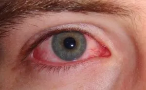 home-remedies-for-swollen-eyes