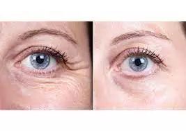 botox before and after eyes