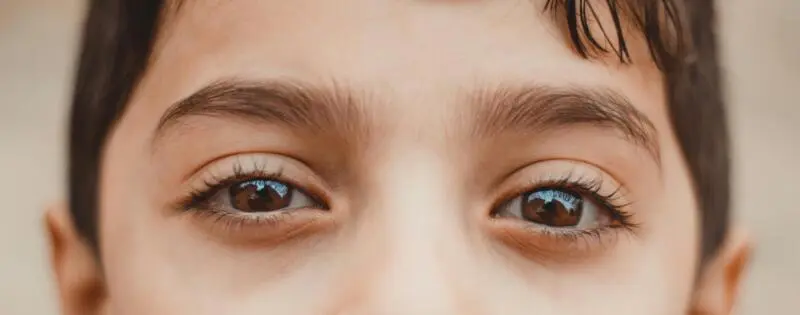 Under Eye Filler Before and After: